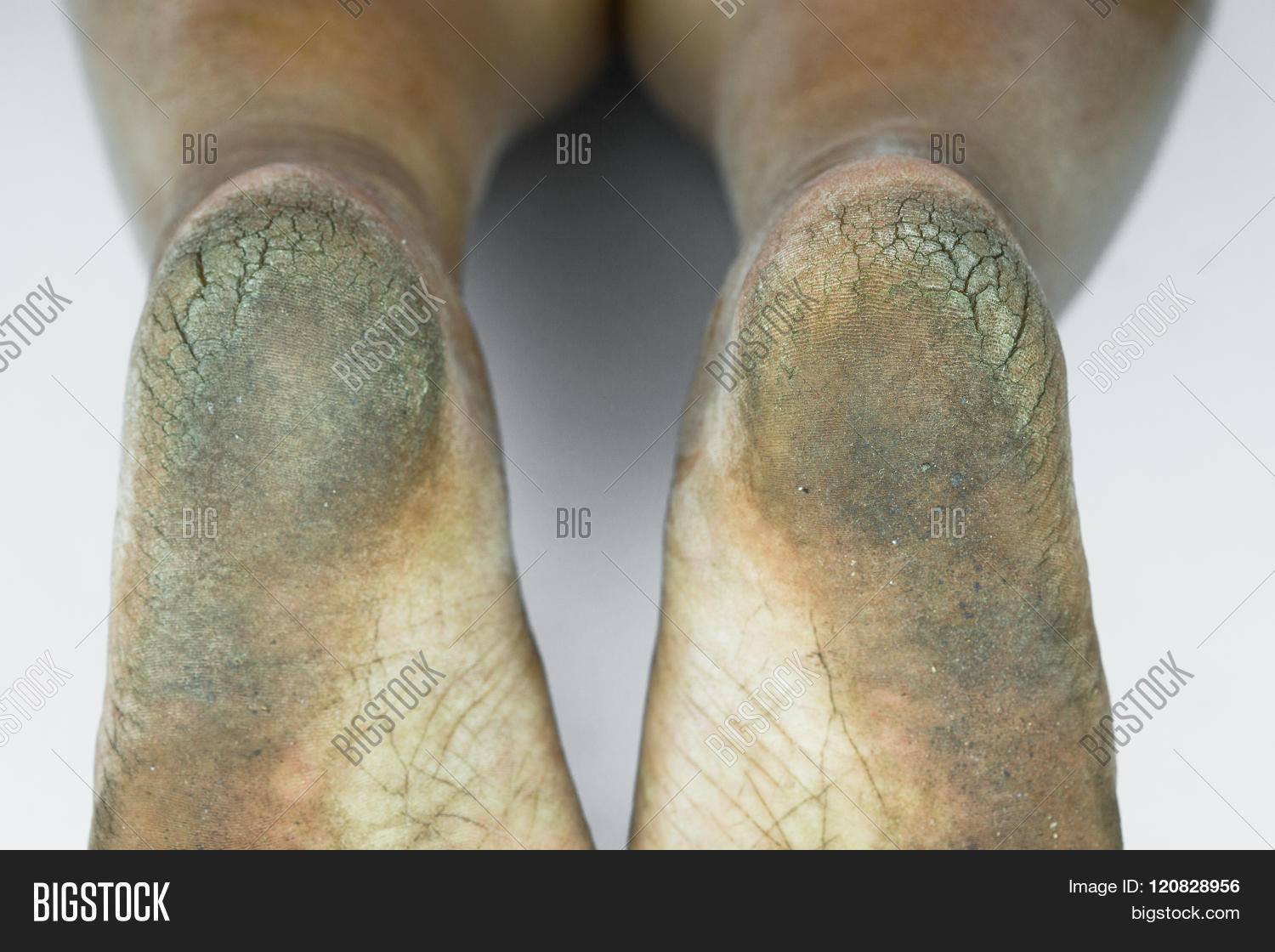Dirty Foot Cracked Heels Isolate On Image & Photo Bigstock