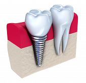 picture of embed  - Dental implant  - JPG 