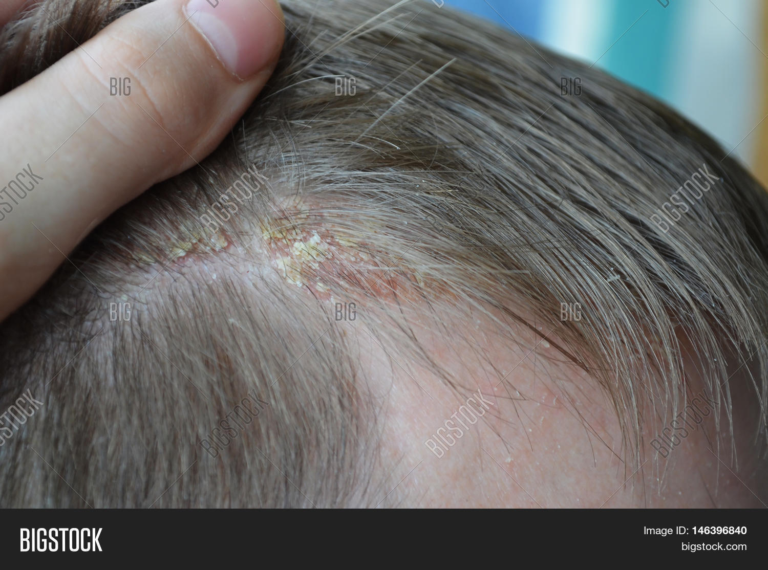 Psoriasis On Hairline On Scalp Image & Photo Bigstock