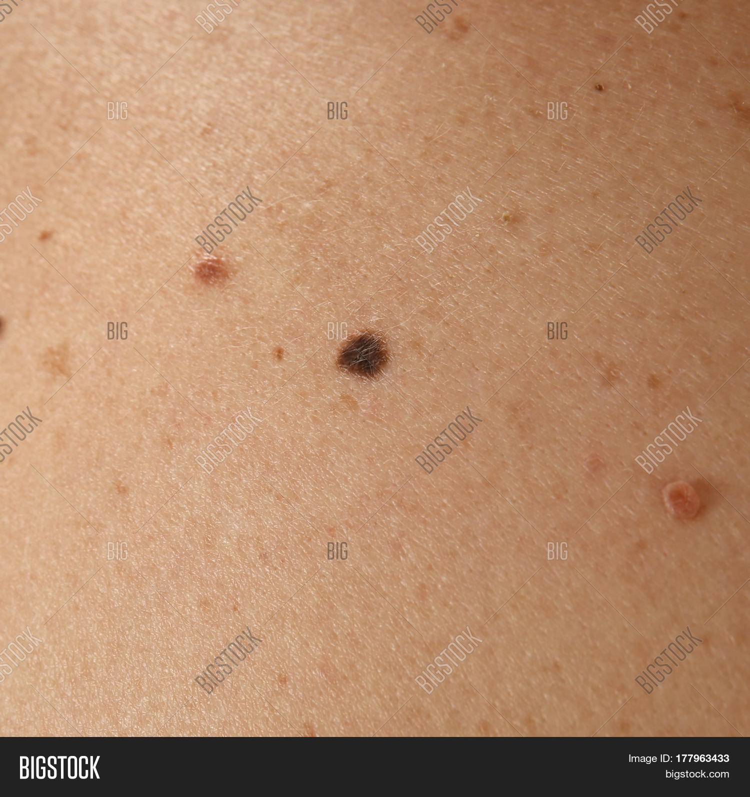 human skin stock photo 169 chaoss 1695911 human skin with birthmarks closeup stock photo stock images bigstock human skin stock photo 169 chaoss 1695911 human skin with birthmarks closeup stock photo stock images bigstock
