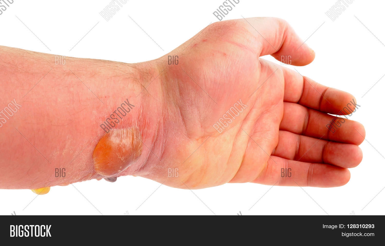 Arm with blisters caused by a severe allergic reaction cause by a horse