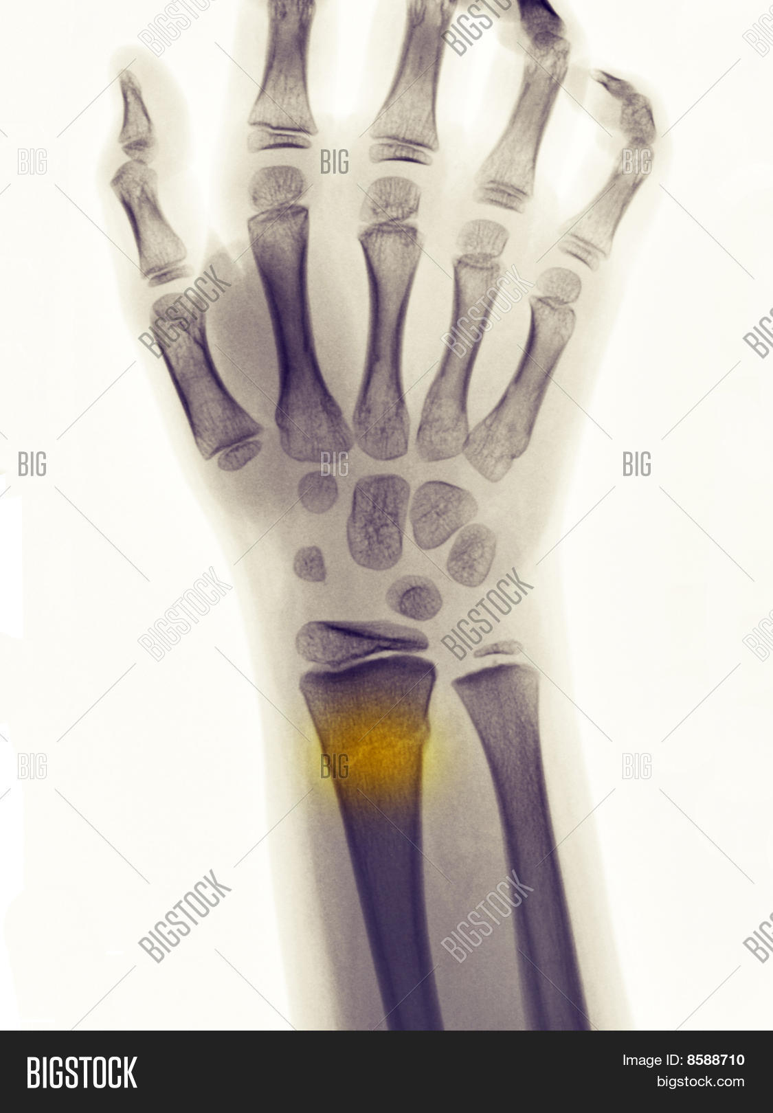 Xray Showing Greenstick Fracture Image & Photo Bigstock
