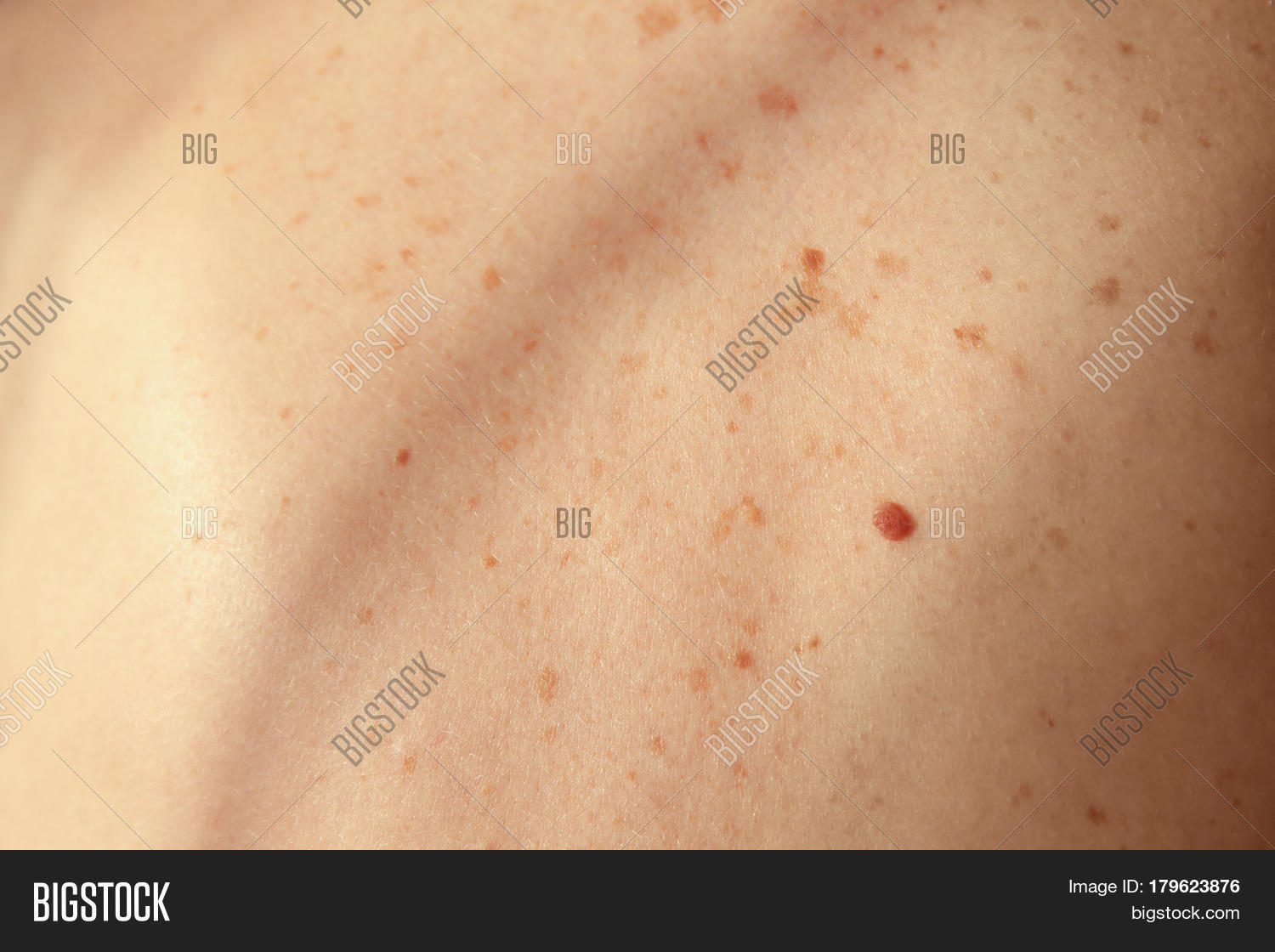 human skin stock photo 169 chaoss 1695911 human skin with birthmarks closeup 库存照片和库存图片 bigstock human skin stock photo 169 chaoss 1695911 human skin with birthmarks closeup 库存照片和库存图片 bigstock
