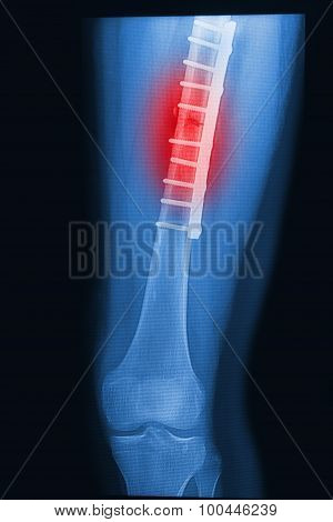 Broken Human Thigh X-rays Image With Implant ( Plate And Screw )