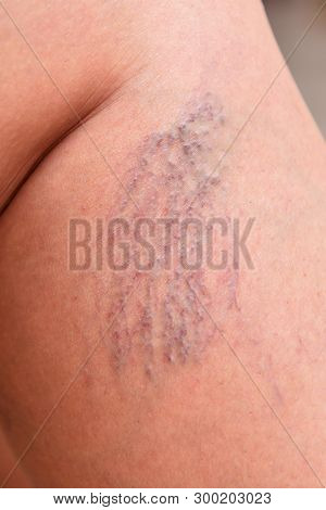 Varicose Veins On Female Legs In The Area Of The Knee And Calves. Sipder Veins Thigh, Close-up