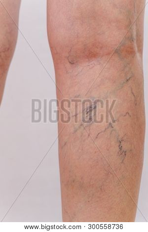 Elderly woman in white panties shows cellulite and varicose veins on a light isolated background. Co