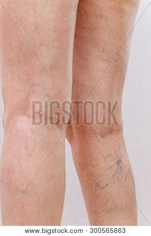 Elderly woman in white panties shows cellulite and varicose veins on a light isolated background. Co