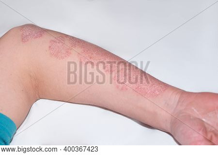 Male Hand With Psoriasis Disease. The Medical Problem Is Psoriasis.eczema Skin Disease Psoriasis On