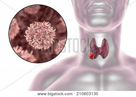 Thyroid cancer. 3D illustration showing thyroid gland with tumor inside human body and closeup view of thyroid cancer cells