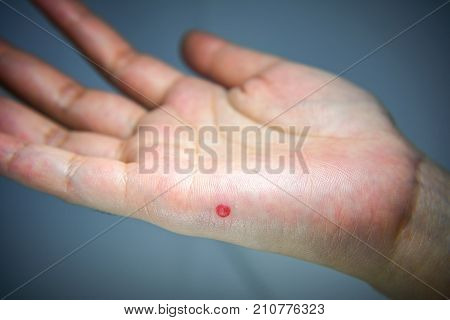 Blood Blister forming on the side of the hand