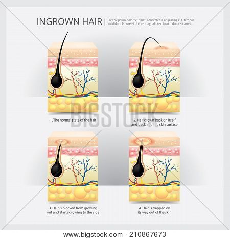 Ingrown Hair Structure Info Graphic Vector Illustration