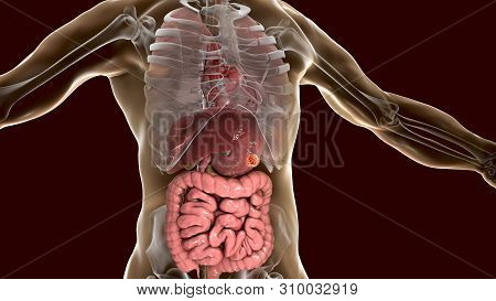 Stomach Cancer, Gastric Carcinoma, 3d Illustration Showing Anatomy Of Human Body And Cancerous Tumor