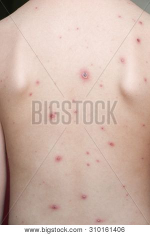 Chicken Pox Rash On Young Boy Body.chickenpox Is An Infection Caused By The Varicella Zoster Virus. 