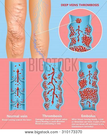 Deep Vein Thrombosis Or Blood Clots. Embolus. Structure Of Normal And Varicose Female Veins. Illustr