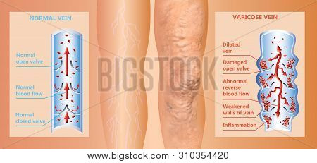 Varicose Vein On A Female Senior Legs. The Structure Of Normal And Varicose Veins. Concept Of Dry Sk