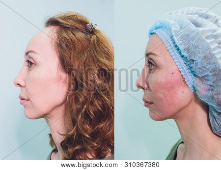Aged Woman Doing Mesothreads And Thread Lifting, Cosmetology. Cosmetic Procedure To Eliminate Signs 