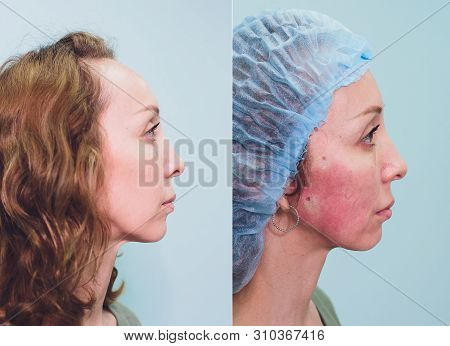 Aged Woman Doing Mesothreads And Thread Lifting, Cosmetology. Cosmetic Procedure To Eliminate Signs 