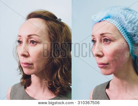 Aged Woman Doing Mesothreads And Thread Lifting, Cosmetology. Cosmetic Procedure To Eliminate Signs 