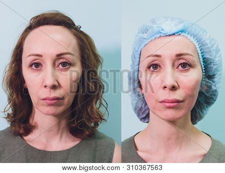 Aged Woman Doing Mesothreads And Thread Lifting, Cosmetology. Cosmetic Procedure To Eliminate Signs 