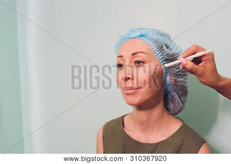 Aged Woman Doing Mesothreads And Thread Lifting, Cosmetology. Cosmetic Procedure To Eliminate Signs 