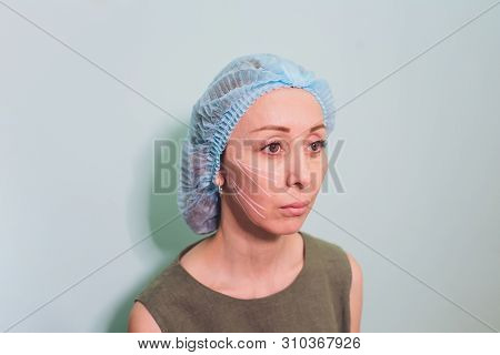 Aged Woman Doing Mesothreads And Thread Lifting, Cosmetology. Cosmetic Procedure To Eliminate Signs 