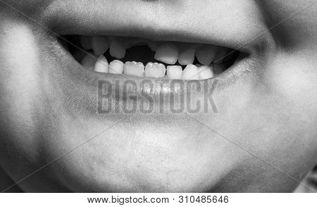 Seven-year-old Child. Replacing Milk Teeth With Permanent Ones. Close-up Shot Of A Fallen Tooth. Bla