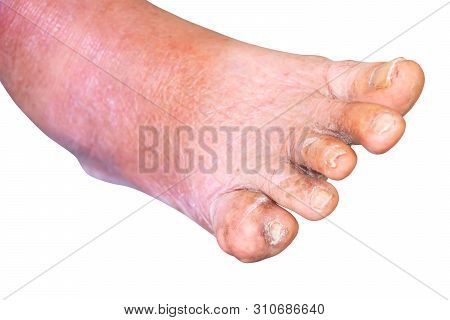 Gout Foot Little Finger In Aged People Close Up On White Background