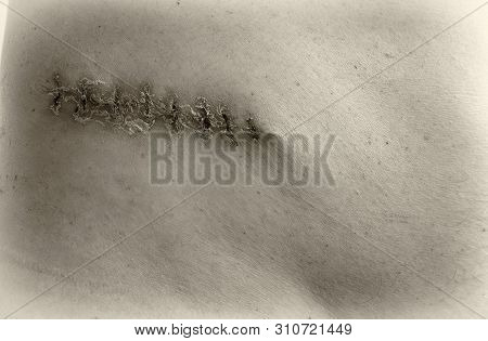 The Picture Shows A Medical Scar After Surgery After Removal Of A Malignant Tumor - A Bad Birthmark.