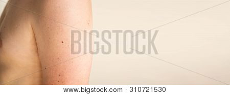 Close Up Detail Of The Bare Skin On A Man Back With Scattered Moles And Freckles. Checking Benign Mo