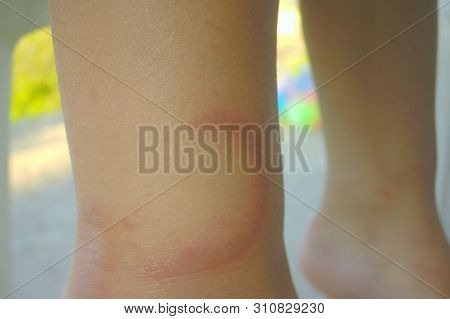 Mark Of Bite Jellyfish. Jelly Fish Pelagia Noctiluca Wound On Human Skin