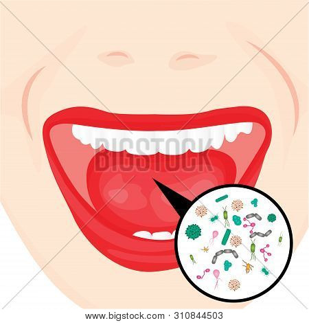 Bacterial Overgrowth In A Mouth.  Flu, Cold, Other Contageous Diseases Vector Illustration On A Whit