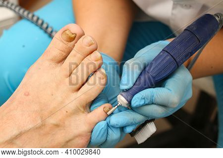 Doctor Treats An Ingrown Toenail With A Medical Instrument, Removal And Disinfection
