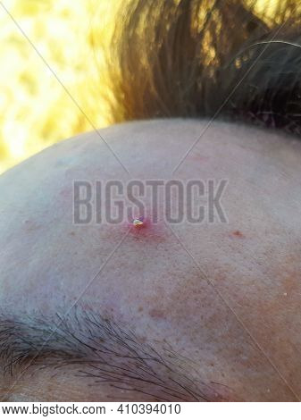 Macro Shot Of A Red Irritated Pimple With White Pus Squeezed Out On A Forehead Of A Male. Skin Probl
