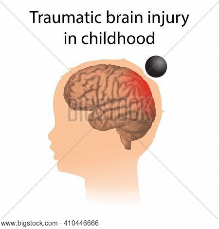 Tbi. Traumatic Brain Injury In Childhood. Kid, Child Head Damage.