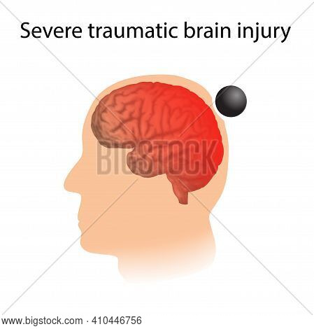 Tbi. Severe Traumatic Brain Injury. Head Damage.