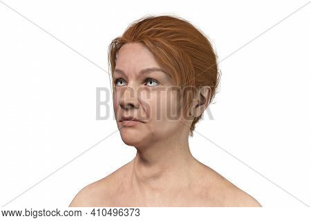 Thyroid Tumor, 3d Illustration Showing Nodule Inside Thyroid Gland