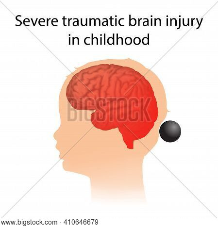 Tbi. Severe Traumatic Brain Injury In Childhood. Kid, Child Head Damage.