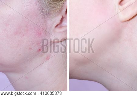 Young Woman Before And After Anti Acne Treatment, Skincare And Dermatology Concept