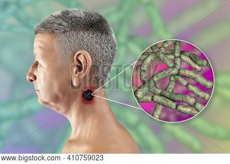Cutaneous Anthrax, The Most Common Form Of Anthrax. 3d Illustration Showing The Characteristic Black