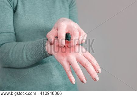 The Girl In The Gray Jumper Scratches Her Hand. Scabies. Inflammation Of The Skin. Disease Of The Sk