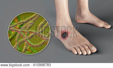 Cutaneous Anthrax, The Most Common Form Of Anthrax. 3d Illustration Showing The Characteristic Black