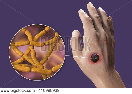 Cutaneous Anthrax, The Most Common Form Of Anthrax. 3d Illustration Showing The Characteristic Black