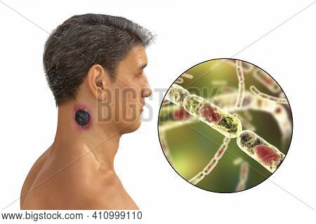 Cutaneous Anthrax, The Most Common Form Of Anthrax. 3d Illustration Showing The Characteristic Black