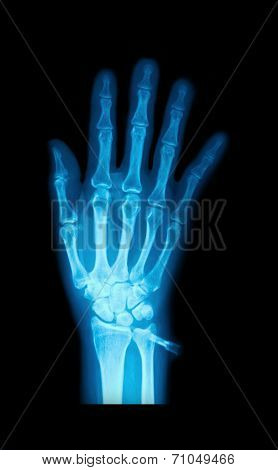 X-ray Image Of Human Hands