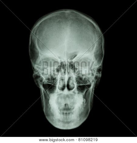 X-ray Skull And Stroke ( Cerebrovascular Accident (cva) )