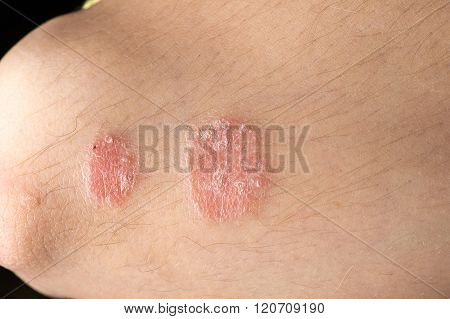skin disease psoriasis