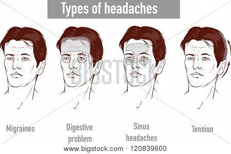 Illustration About Headaches 4 Type On Different Area Of Patient Head.