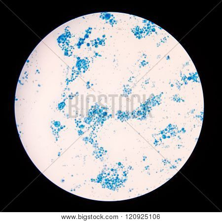malignant cells with multiple nuclei and prominent nucleoli.Mesothelial cells
