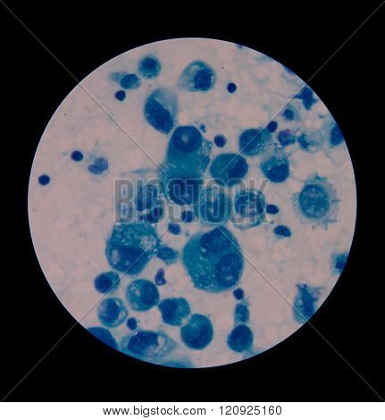 malignant cells with multiple nuclei and prominent nucleoli.Mesothelial cells