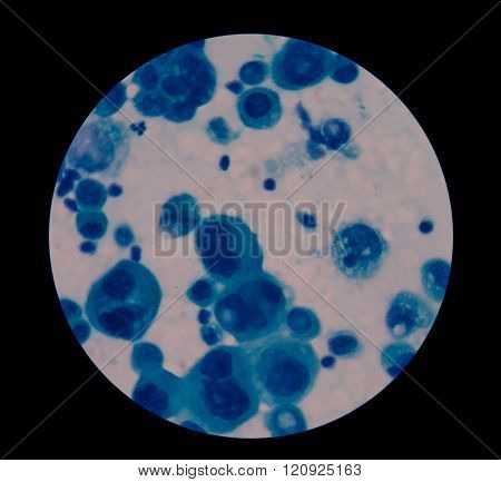 malignant cells with multiple nuclei and prominent nucleoli.Mesothelial cells